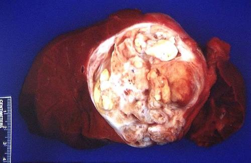 卵巢畸胎瘤一定要做手术吗