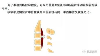 颈椎后纵韧带骨化症(OPLL)影像学表现的临床研究