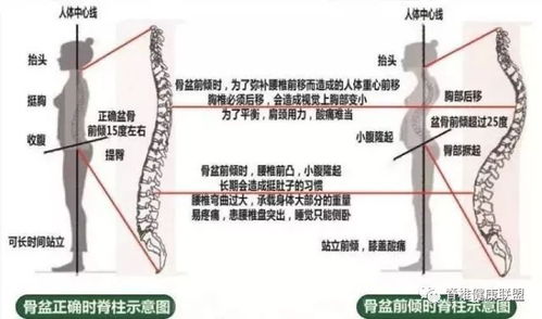 骨盆前倾如何诊断以及康复训练方法