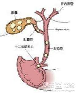 胆囊炎结石不能吃什么