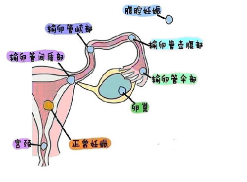 宫外孕前期征兆(宫外孕早期症状有哪些)
