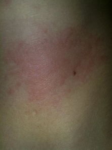 我的荨麻疹是慢性的吗 
