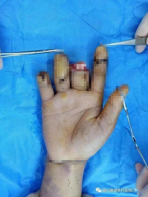 缝 两根, 变 一根,工人师傅断了的手指重新 长 出来