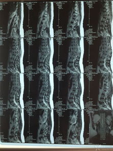 腰椎爆裂性骨折