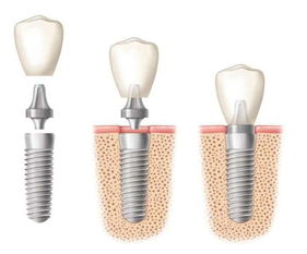 带临时牙冠会影响种植牙吗