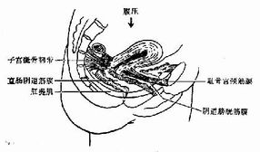 妇产科学 第十九章 生殖器官损伤性疾病 