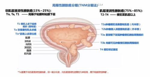 非肌层浸润性膀胱癌膀胱灌注治疗专家共识