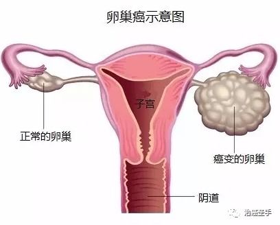 卵巢恶性肿瘤的症状有哪些