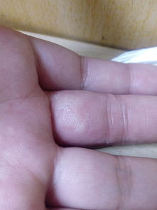 这手指是什么皮肤病 