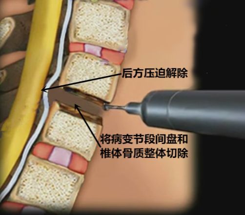 不知道这 3 类颈椎病手术,你还敢做手术