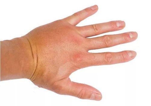 偏瘫患者为什么会手肿 有可能是你自己造成的,别大意
