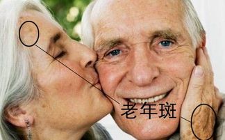 去老年斑的偏方