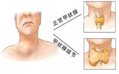 生活中如何缓解甲状腺结节的症状 代文新主任 请在饮食列表中把2件东西划掉