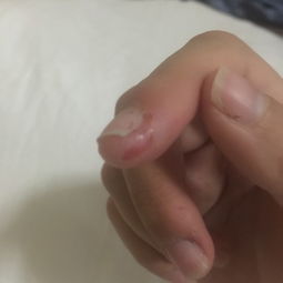 手指甲左边的甲肉肿了 肿的地方有点发白 挺痛的 什么原因 