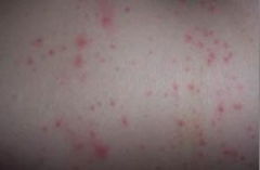 人工荨麻疹的症状有什么