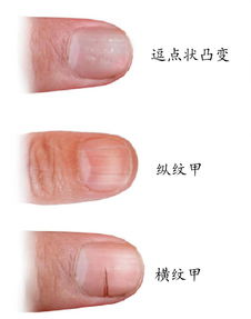 指甲横纹凹陷 指甲上有横纹是怎么回事？ 