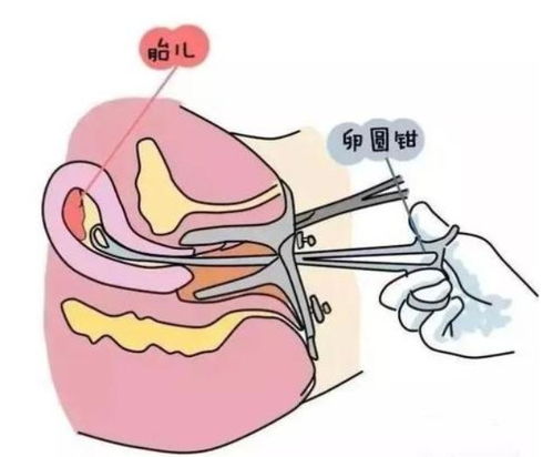 女人打胎不能超过几次,超过这个数,身体就毁了