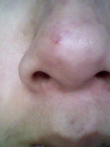 维生素e干什么用 鼻子上长了个挺大痘痘 可难看了 就挤 然后就可红了 还凹进去了 留下了疤 