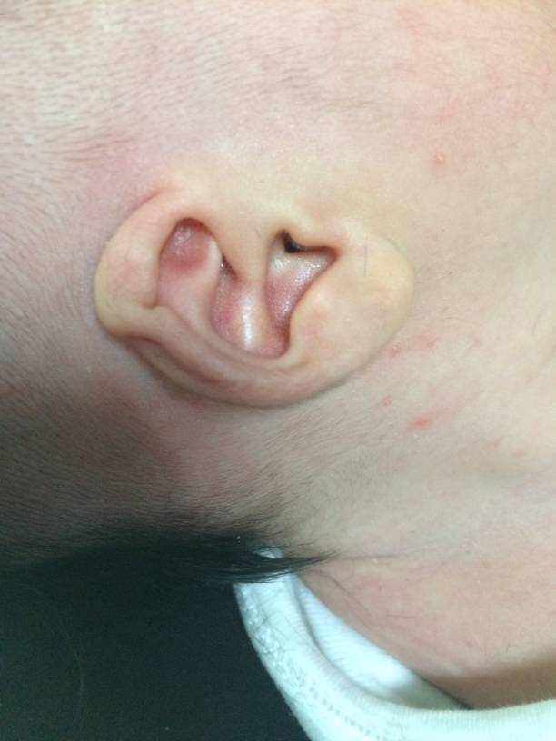 什么是耳朵畸形 