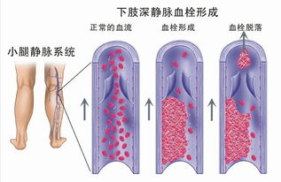 下肢静脉血栓有致命危险 常做这3个小动作能救命,一定要知道