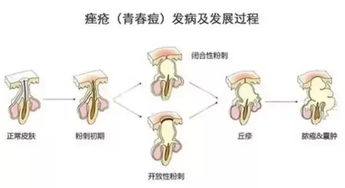 魅颜黛雅分享 青春痘饮食的预防知识... 