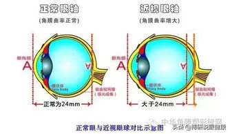 国际医学眼科中心 近视不可怕,可怕的是近视疯狂增长