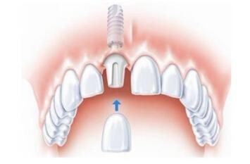 诚嘉口腔介绍影响种植牙效果的 3道平安符 