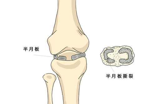 为什么我做完半月板囊肿手术不用戴支具