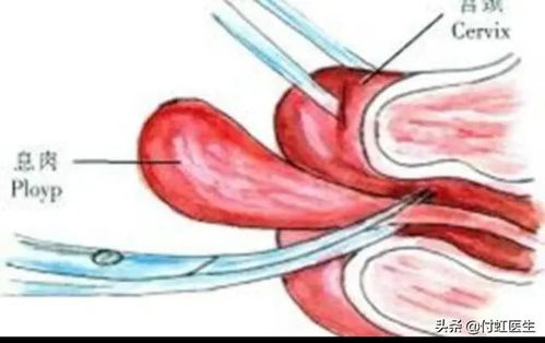 宫颈糜烂 宫颈纳囊 宫颈息肉 宫颈湿疣 HPV,看这一篇够了