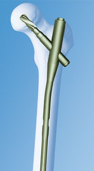 上海市东方医院骨科采用新技术 PFNA新型股骨近端髓内钉