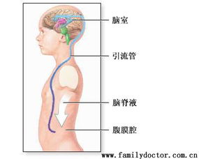 浅谈腹腔引流的临床意义