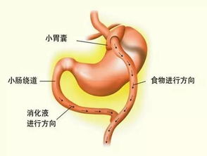 肥胖症的治疗方法有哪些 