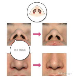 鼻翼 鼻头缩小整形有哪些手术方法 及其副作用,会增生否 