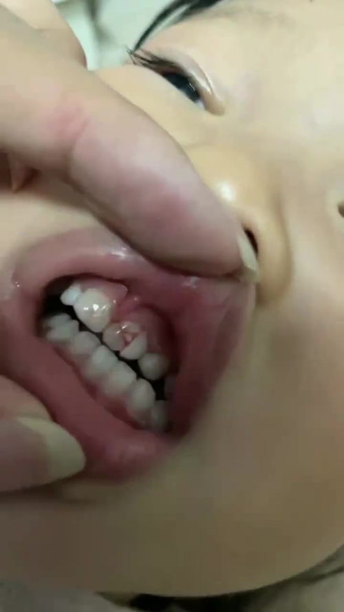 九岁的小女孩把大门牙摔断了该怎么修复(九岁女孩门牙磕掉一半可不可以修?)