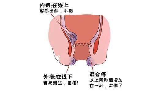 肛肠疾病都会发生便血,不是只有痔疮