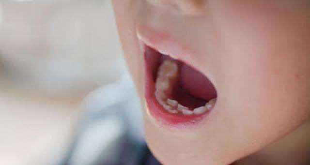 孩子乳牙整齐漂亮,换牙后却越长越丑 这些 毁牙 习惯孩子有吗