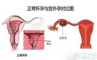 宫外孕常见的原因有哪些