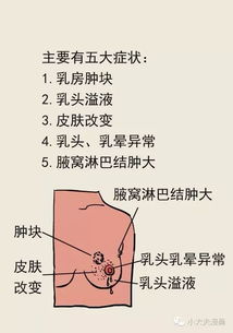 乳腺癌成女性健康 头号杀手 ,乳腺癌预防知识你了解多少