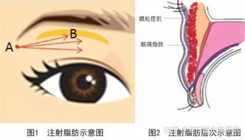 自体脂肪填充眼窝多久能吸收变自然 