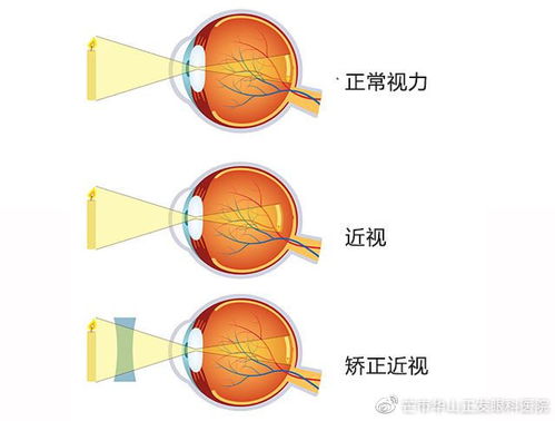 青少年近视的危害,你确定都了解吗