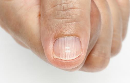 手指甲凹陷图片 指甲凹下去了是怎么回事？应该怎么办？ 