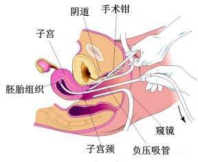 西安孕妇做人流后胎儿仍存在 医生 漏吸了