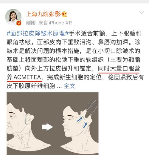 手术拉皮是什么意思 拉皮费用多少