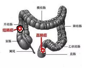 结肠癌了怎么处理？