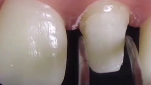 修复牙齿的过程,牙根只剩一点也不一定要拔除,还是有很多方法的 