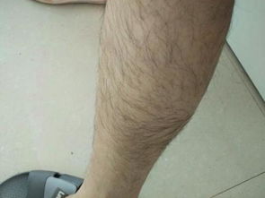 男孩子腿上长汗毛是正常现象吗