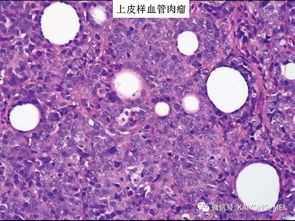 淋巴梭形细胞1.85,淋巴细胞数目超出正常值范围会引起什么病