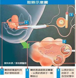 捐卵过程，捐卵有什么坏处