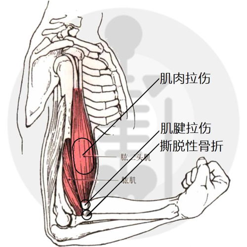 拉伤和劳损有哪些不同的症状？