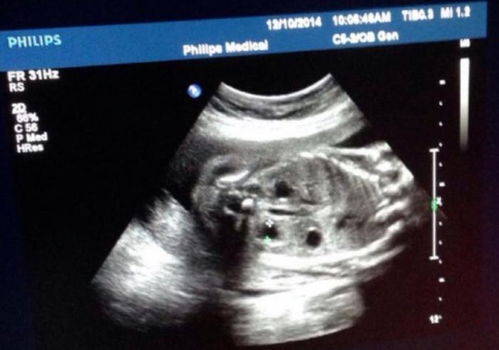 怀孕8个月胎儿b超图？女宝b超图典型的